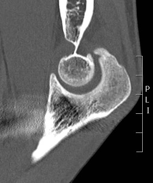 Elbow Arthritis CT